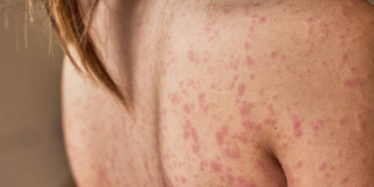 Caring for Psoriasis-Prone Skin
