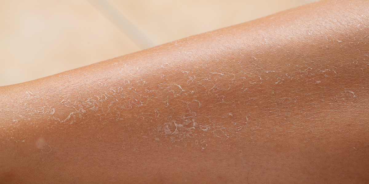 1 in 10 People Have the Dry Skin Gene and 50% of People With Eczema Have It, Do You?