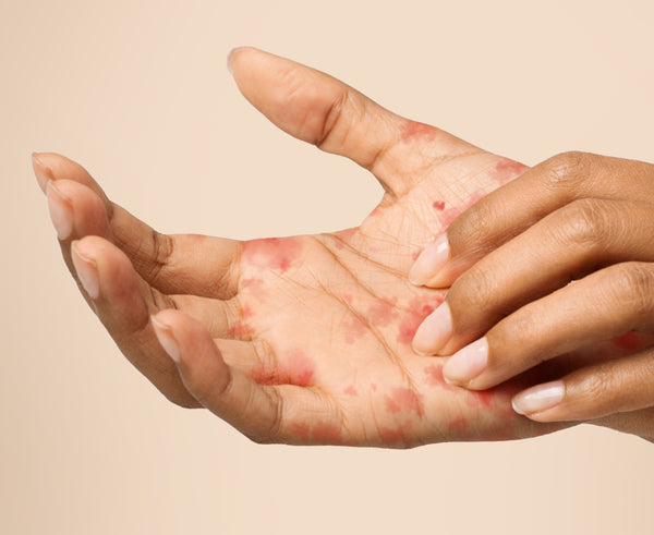 ECZEMA PRONE SKIN