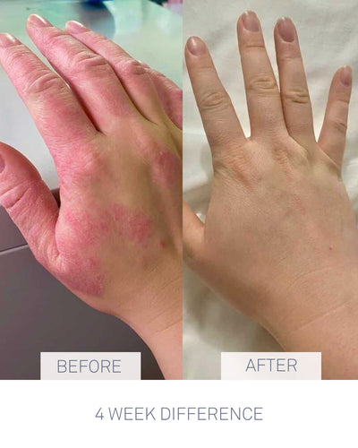Nursem Caring Skin Fix before and after