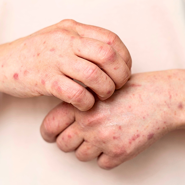 Eczema prone skin