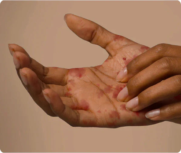 Eczema Prone Skin